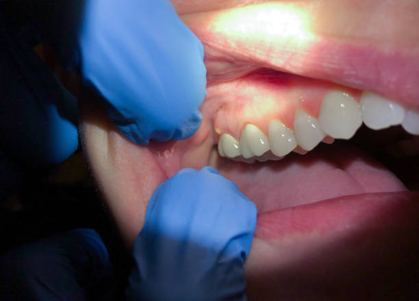 Best Emergency Dentist for Knocked-Out Tooth in Ashwaubenon, WI